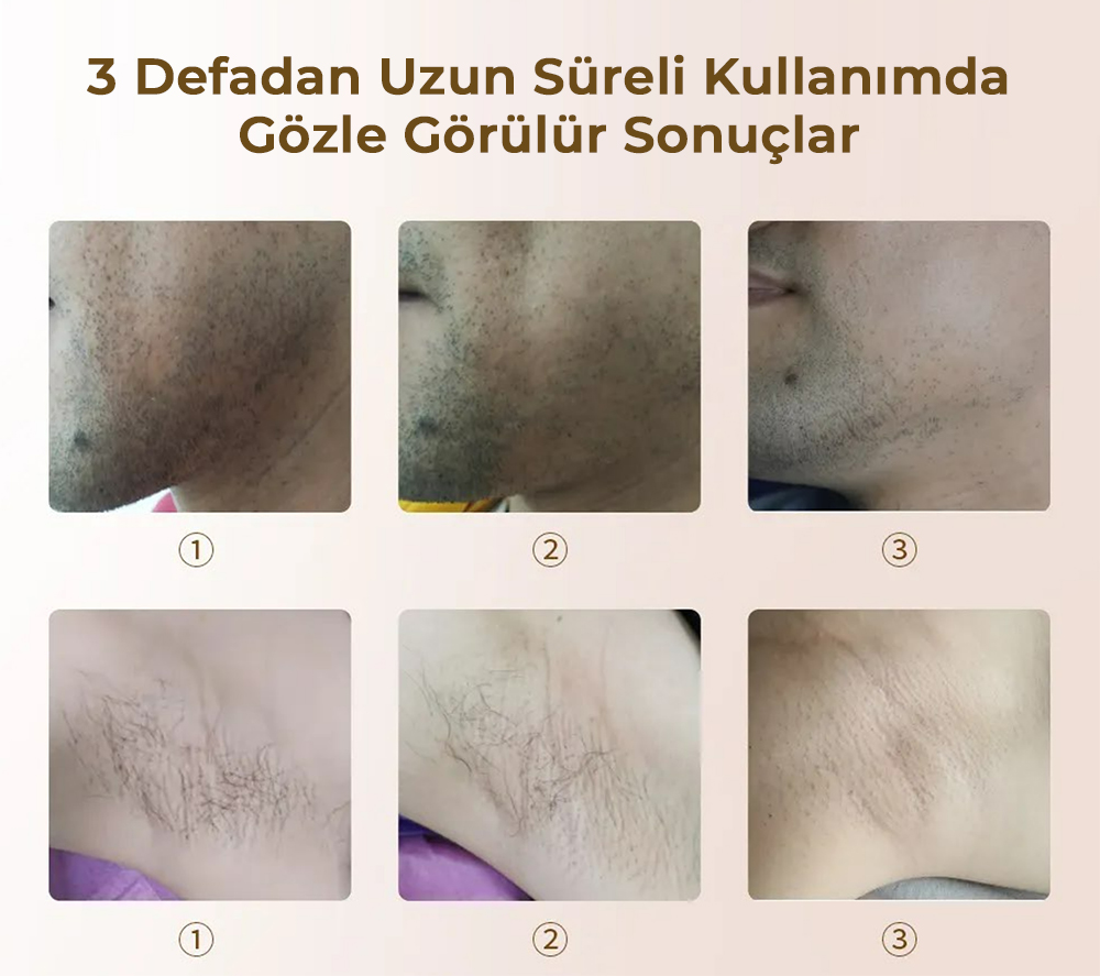 Sınırsız Atımlı Lazer Epilasyon Yasomi