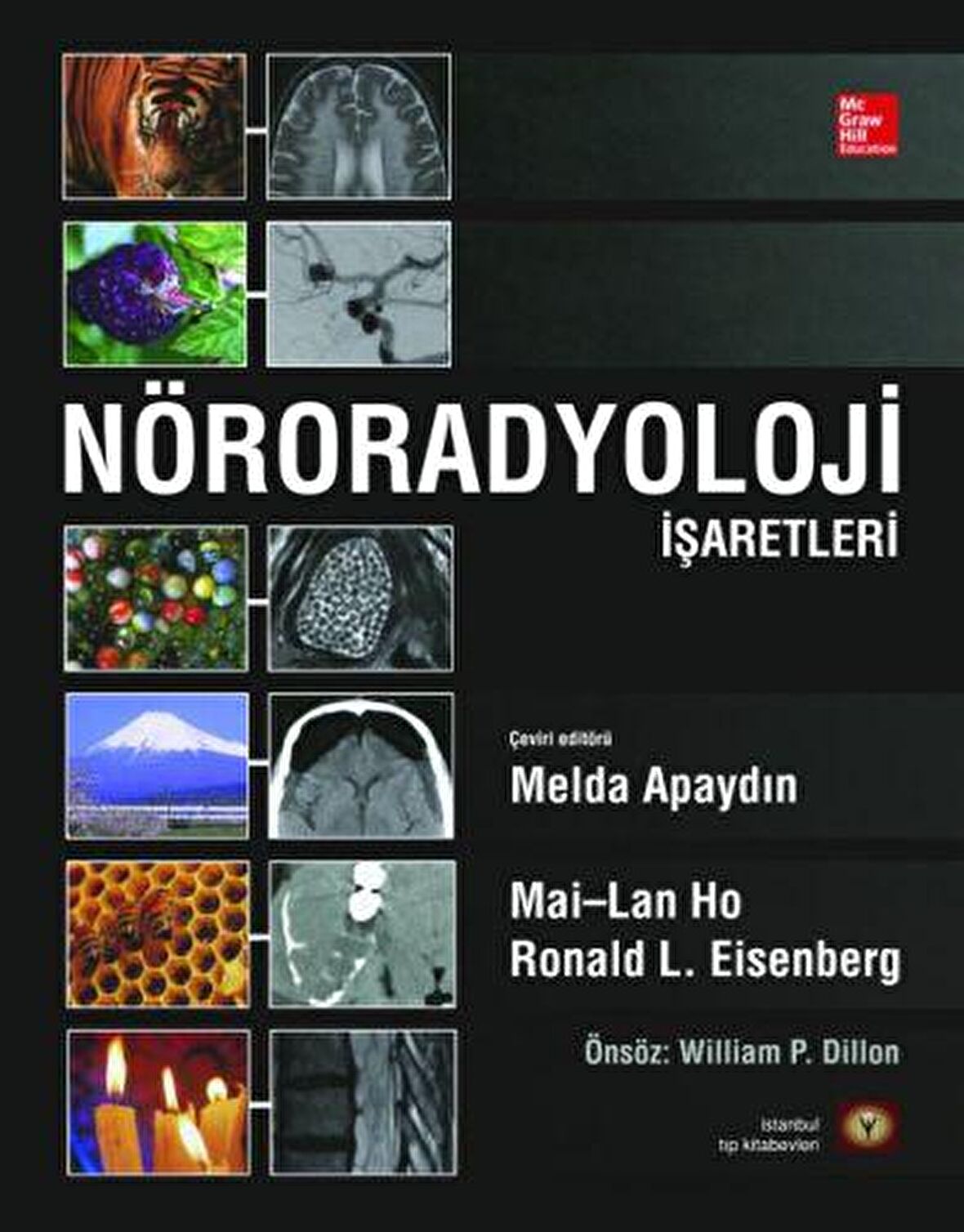 Nöroradyoloji İşaretleri