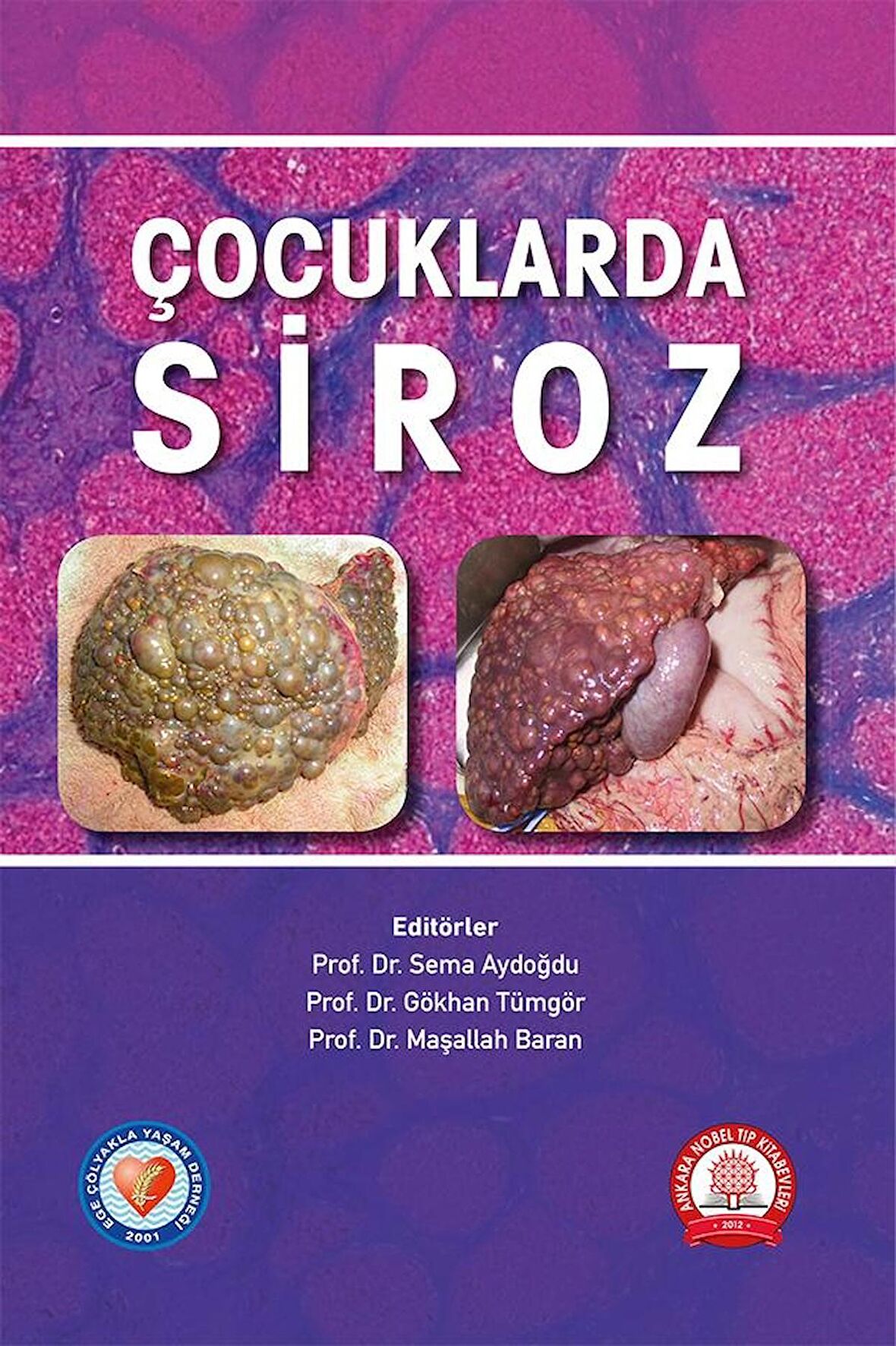 Çocuklarda Siroz