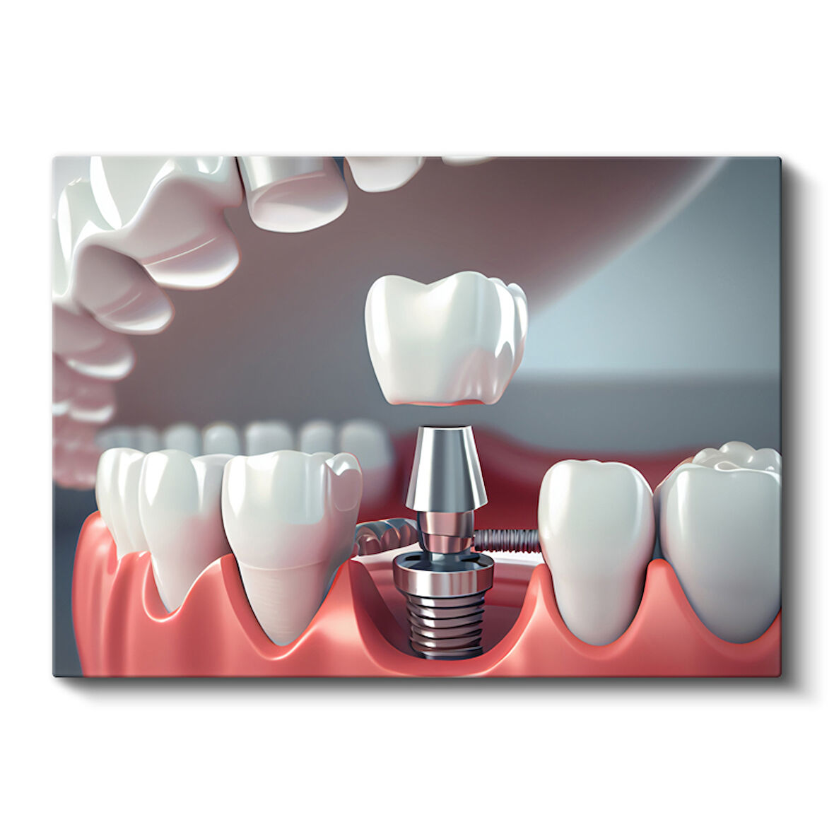Modern Diş İmplantı Teknolojisi Dekoratif Kanvas Tablo