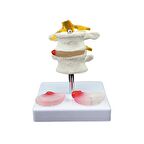 Lumbar Vertebra Disk Hernisi Omurga Modeli Model 4