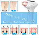 nwn3 Acısız IPL Buz Lazer Epilasyon Cihazı 999.999 Flaş Atım Tüm Vücut - Yüz