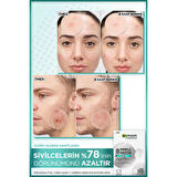 Pimple Patch 22'li Sivilce Bandı / Hidrokolloid Bant