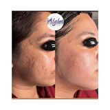 Algler Yosun Peeling Tanışma Paketi 5 Uygulama Ücretsiz Eğitim