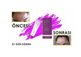 MyMe Tüm Cilt Tipleri İçin Akne Karşıtı Alkolsüz-Parabensiz Gece-Gündüz Akne Kremi  30 ml 