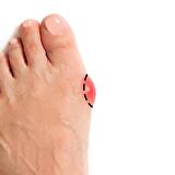 Bunyon Yüksek Kalite - Baş Parmak Koruyucu Halluks Valgus Makarası -bgm