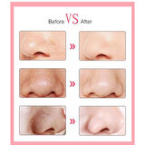 6 Başlıklı Vakumlu Siyah Nokta Temizleyici