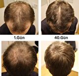 purexpose saç bakım saç çıkaraıcı serum 2adet 1dermaroller hediyeli