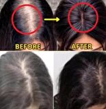 purexpose saç bakım saç çıkaraıcı serum 2adet 1dermaroller hediyeli