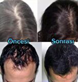 purexpose saç bakım saç çıkaraıcı serum 2adet 1dermaroller hediyeli