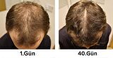 purexpose saç dökülmesi saç çıkaran serum 5adet 1dermaroller hediyeli