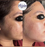 Yosun Peeling 30 Kullanımlık