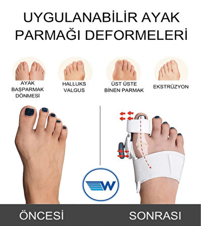 HALLUKS VALGUS SPLİNTİ PRATİK SİSTEMLİ (TEK) W656