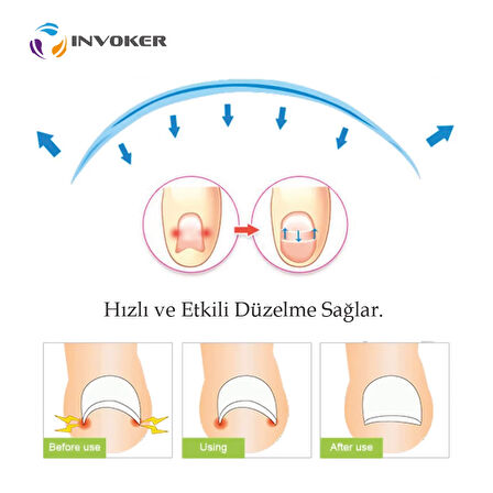 Tırnak Batması Engelleyici Tırnak Düzeltici Yapıştırmalı Batık Tırnak Çıkartıcı Atel