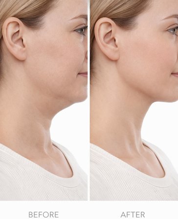 Lenf Drenaj Fırçası – Yüz ve Vücut İçin Kuru Masaj Fırçası, Selülit Azaltıcı, Cilt Arındırıcı, Lenfatik Akış Destekleyici, Ergonomik Saplı, Şekillendirici Masaj Aracı