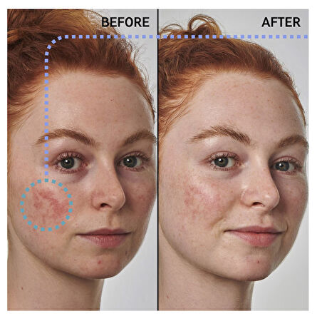 THE INKEY LIST Redness Solution with 10% Azelaic - Yüz Serumu 30 ml 