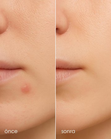 Clearly Spot Patch, Sivilce Karşıtı Şeffaf Plaster | Şeffaf, Ultra İnce, Hidrokolloid + Niacinamide + Salicylic Asit İçerikli Akne Karşıtı Yüz Bandı | 24 Adet