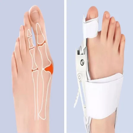 Ayarlanabilir Ayak Baş Parmak Kemik Düzeltici – Halluks Valgus (Bunyon) Aparatı, Gece Gündüz Kullanı