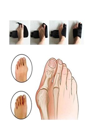 Halluks Valgus Ayak Ateli Ayak Başparmak Kemiği Çıkıntısı Bunyonu Düzeltici