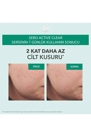 Süksinik Asit & Çinko İçerikli Sebum Dengeleyici Gözenek Sıkılaştırıcı Yüz Serumu - 30 ml