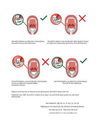 SomnoFit-B, Mandibular (Alt Çene) İlerletme Aparatı                                                