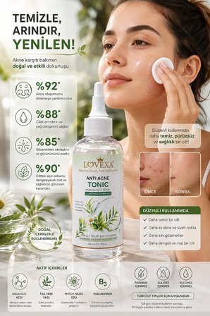 LOVEXA ANTİ ACNE TONİC SEBUM DENGELEYİCİ