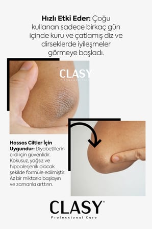 El, Diz Ve Dirsek Bakım Kremi - Çatlamış, Kurumuş, Koyulaşmış Sert Deriye Karşı