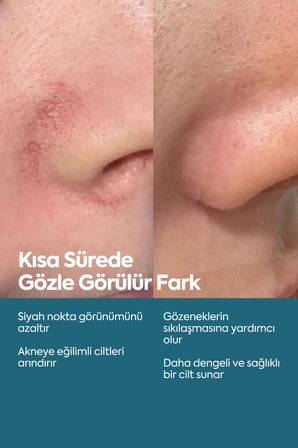 Siyah Nokta Ve Karşıtı, Önleyici Serum, Niasinamid Ve Çinko