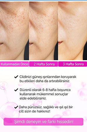 Devida Sivilce Karşıtı,Siyah Nokta,Akne Giderici Serum Anti-Acne Et Anti-Points Noirs