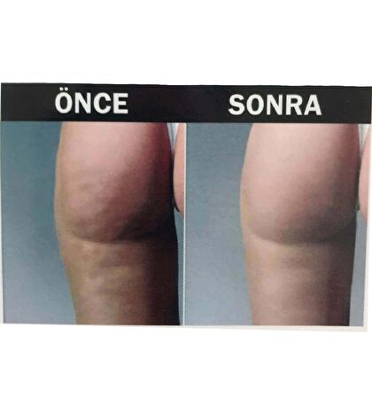 Hema Kadın Anti-Cellulite ( Selülit Giderici ) Masajlı Dikişsiz Paçalı Korse