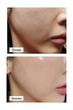 LamuCell PDRN Yaşlanma ve Kırışıklık Karşıtı Bakım Ampulü 50 ml %99 Saflıkta Somon