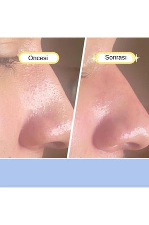 Secret Pure Nose Patch / Siyah Nokta Temizleme Bandı