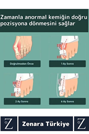 Premium Sağ Sol Her İki Ayak İçin Uyumlu Yıkanıp Kolay Temizlenir Baş Parmak Kemik Düzeltici Atel