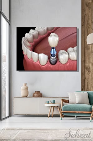 Şehzat Kanvas Tablo Diş Sağlığı Klinik İmplant 20 x 30 cm
