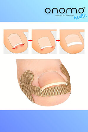 Health Batık Tırnak Düzeltme Bandı 20 Adet