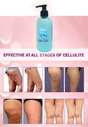 Lipo Cold 2 Adet Fazla Yağlarınıza ve Selülitlerinize Karşı Krem 250 ml