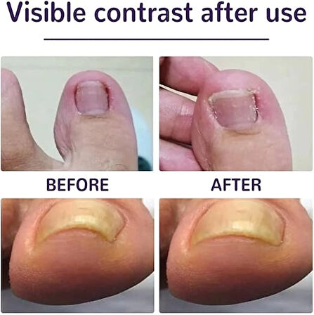 Ayak Tırnağı Düzeltme Bandı 50 Adet