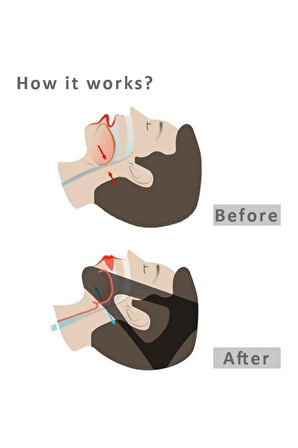 Ayarlanabilir Horlama Bandı Uyku Bandı Maskesi Uyku Apnesi Tedavisi