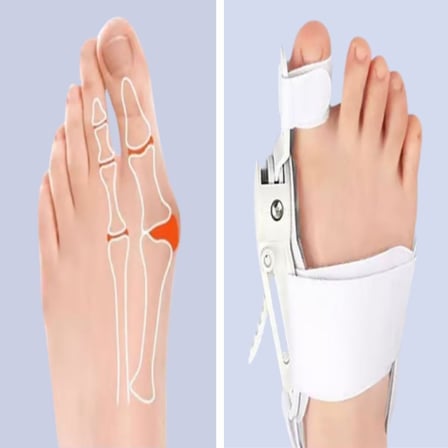 B Ayarlanabilir Ayak Baş Parmak Kemik Düzeltici – Halluks Valgus (Bunyon) Aparatı, Gece Gündüz Kullanıma Uygun Ayak Düzeltme Ateli
