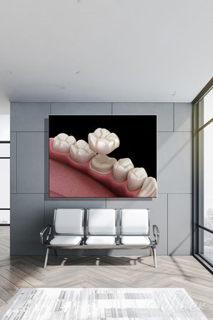 Kanvas Tablo Yatay Tekli  Ağız Diş Sağlığı Diş Tacı Dental Crown Sabit Protez Türü 2959