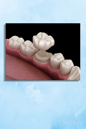 Kanvas Tablo Yatay Tekli  Ağız Diş Sağlığı Diş Tacı Dental Crown Sabit Protez Türü 2959