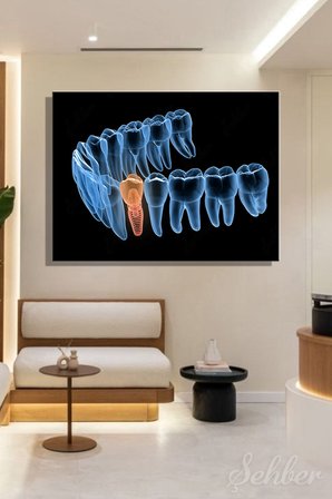 Premolor Dişin İmplant Tedavisi 3D Tıbbi Çizim Yatay Kanvas Tablo Tekli Ağız Diş Sağlığı 3480