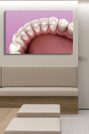 Diş Teli Tedavisinin Ardından Uygulanan Sabit Retainer Teli Yatay Kanvas Tablo Tekli Ağız Diş Sağlığı 3486