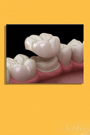 Dental Kuronun Dişe Yerleştirilme Süreci Dijital İllüstrasyon Ağız Diş Sağlığı Yatay Kanvas Tablo Tekli 3500