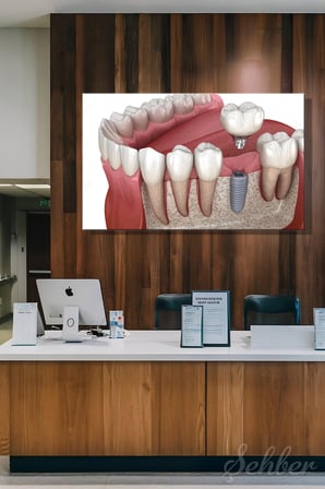 Titanyumdan Üretilen Yapay Bir Diş Kökü Olan Dental İmplant Sistemi Yatay Kanvas Tablo 3509