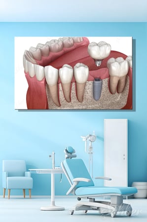 Titanyumdan Üretilen Yapay Bir Diş Kökü Olan Dental İmplant Sistemi Yatay Kanvas Tablo 3509