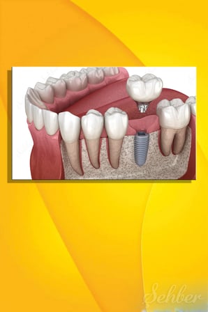 Titanyumdan Üretilen Yapay Bir Diş Kökü Olan Dental İmplant Sistemi Yatay Kanvas Tablo 3509