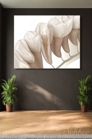 Kök Kanal Tedavisini Gösteren Profesyonel Bir Endodontik Kanvas Tablo Yatay Ağız Diş Sağlığı 3514