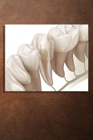 Kök Kanal Tedavisini Gösteren Profesyonel Bir Endodontik Kanvas Tablo Yatay Ağız Diş Sağlığı 3514