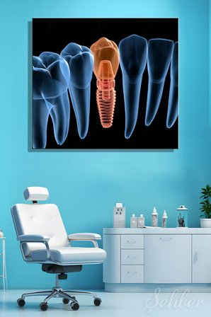 Küçük Azı (Premolar) Dental İmplant Tıbbi 3D İllüstrasyon Yatay Kanvas Tablo Tekli 3652